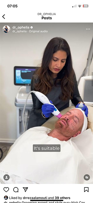 social thermage treatment press. skin tightening facial treatmentq