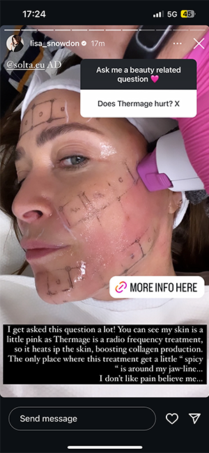 social lisa thermage treatment press. skin tightening facial treatmentq